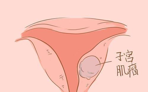 治疗子宫肌瘤多少钱才能好起来呢?